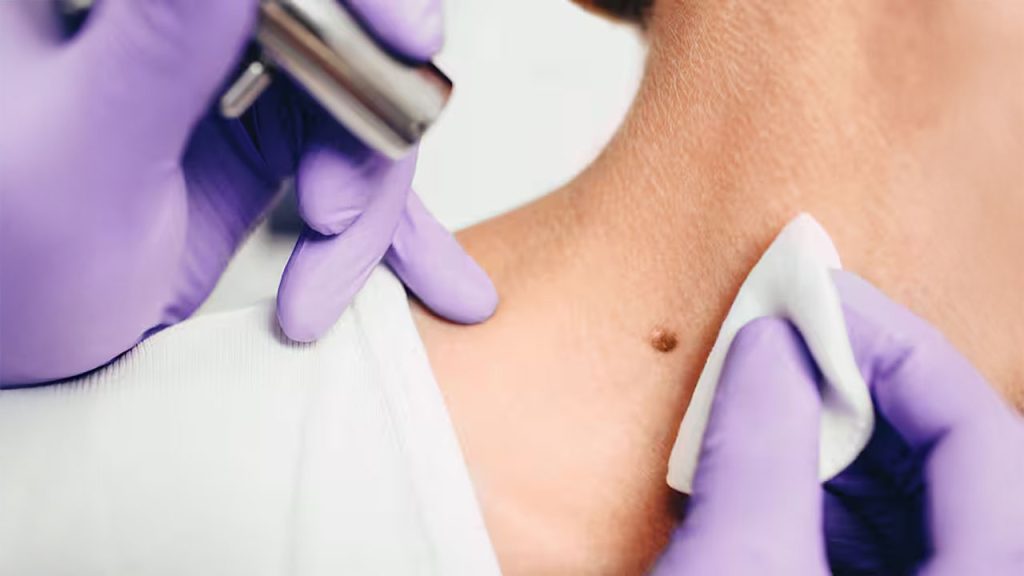 La nueva inmunoterapia contra el melanoma